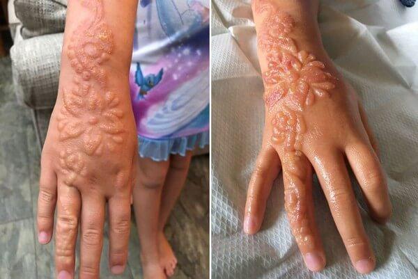 queimadura feita por tatuagem de henna