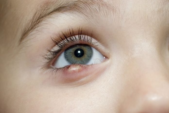 Terçol no olho: É contagioso? Causas e como Curar – Sky Nerd